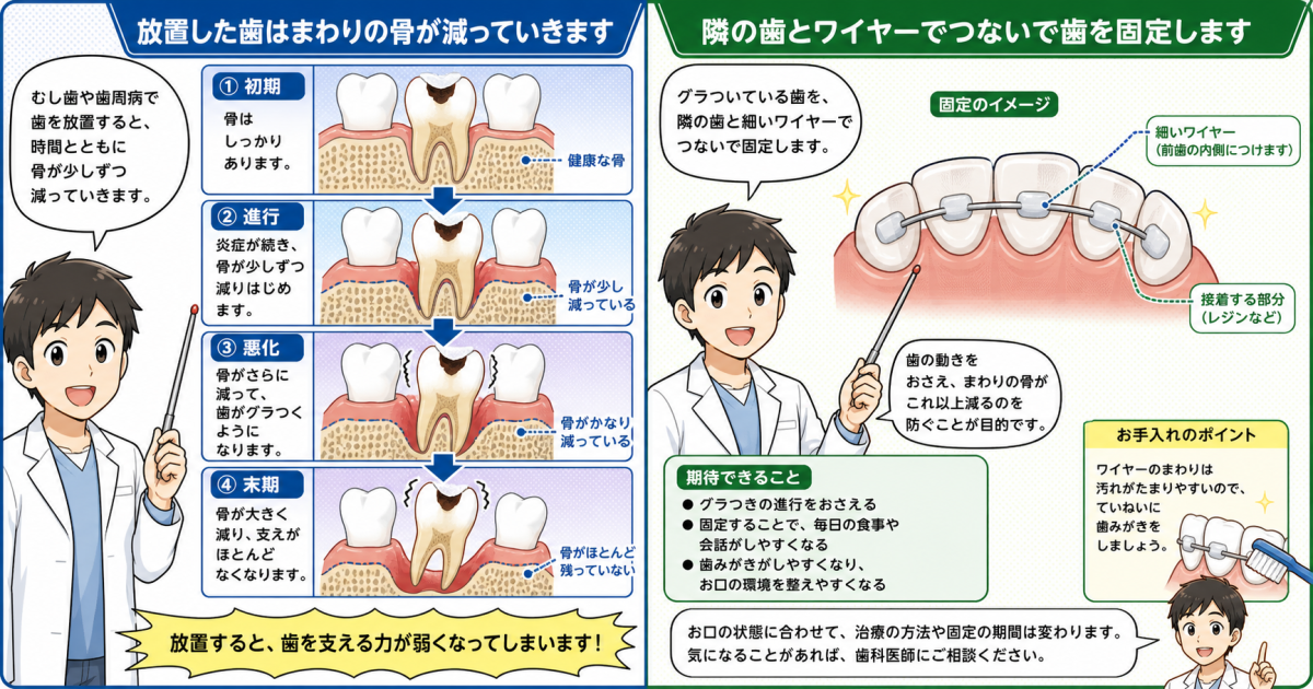 歯がグラグラする主な原因と受診が必要な目安のセルフチェック